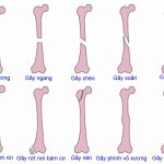 Xử trí gãy thân xương đùi