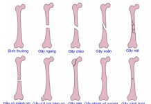 Xử trí gãy thân xương đùi