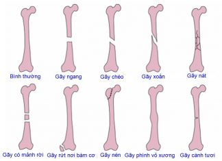 Xử trí gãy thân xương đùi