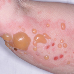 Biểu hiện bệnh bọng nước dạng pemphigus