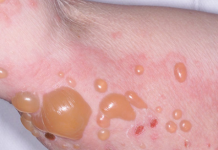 Biểu hiện bệnh bọng nước dạng pemphigus