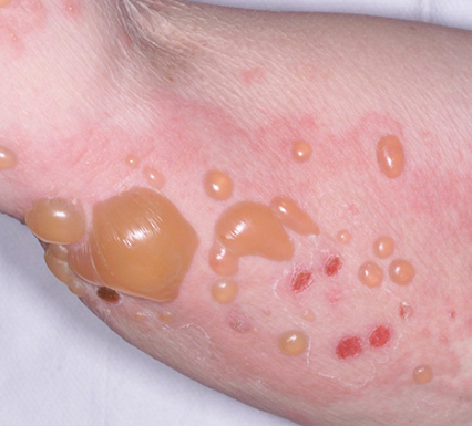 Phân biệt và điều trị Pemphigus