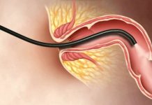 Kỹ thuật nội soi đại tràng