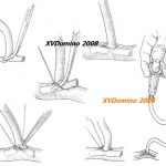 Các ống thông trong phẫu thuật