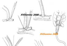 Các ống thông trong phẫu thuật