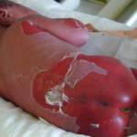 Biểu hiện hội chứng Stevens-Johnson (SJS)