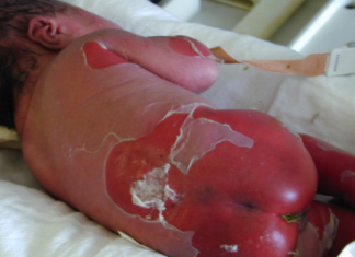 Biểu hiện hội chứng Stevens-Johnson (SJS)