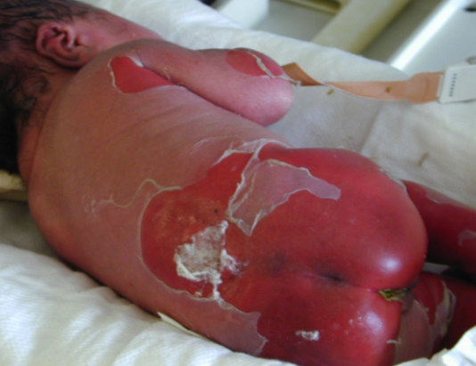 Biểu hiện hội chứng Stevens-Johnson (SJS)