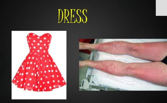 Phân biệt và biểu hiện hội chứng Dress