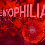 Triệu chứng lâm sàng và chẩn đoán bệnh Hemophilia