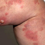 Biểu hiện bệnh viêm da dạng herpes của Duhring-Brocq
