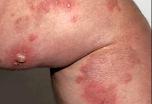 Phân biệt và điều trị bệnh bọng nước dạng pemphigus