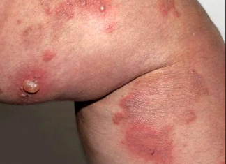 Phân biệt và điều trị bệnh bọng nước dạng pemphigus