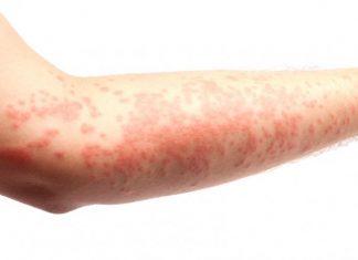 Những điều cần biết về bệnh chàm