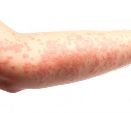 Bệnh da liễu. Triệu chứng, nguy cơ và kỹ thuật chẩn đoán