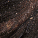 Biểu hiện nấm tóc