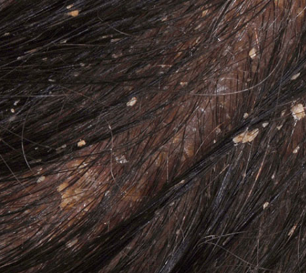 Biểu hiện nấm tóc