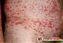 Bệnh nguyên và chẩn đoán bệnh xuất huyết giảm tiểu cầu miễn dịch