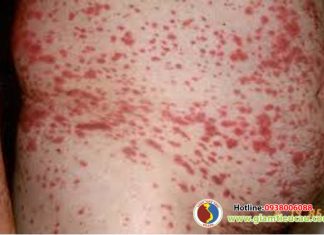 Bệnh nguyên và chẩn đoán bệnh xuất huyết giảm tiểu cầu miễn dịch
