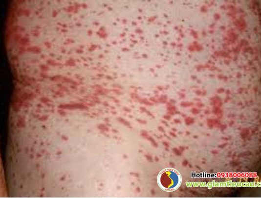 Bệnh nguyên và chẩn đoán bệnh xuất huyết giảm tiểu cầu miễn dịch