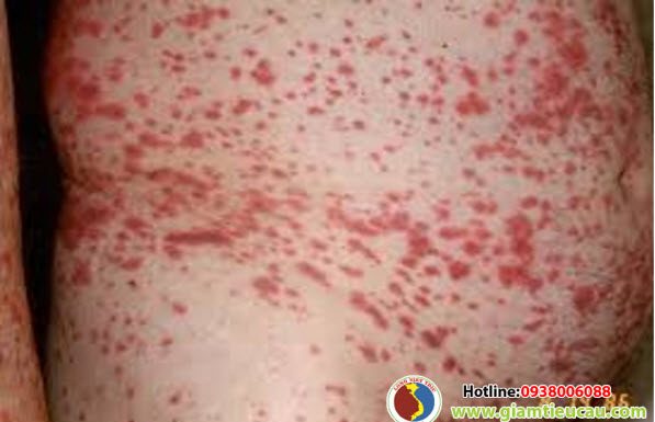 Bệnh nguyên và chẩn đoán bệnh xuất huyết giảm tiểu cầu miễn dịch