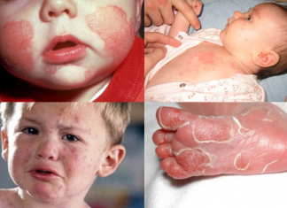 Bệnh giang mai bẩm sinh