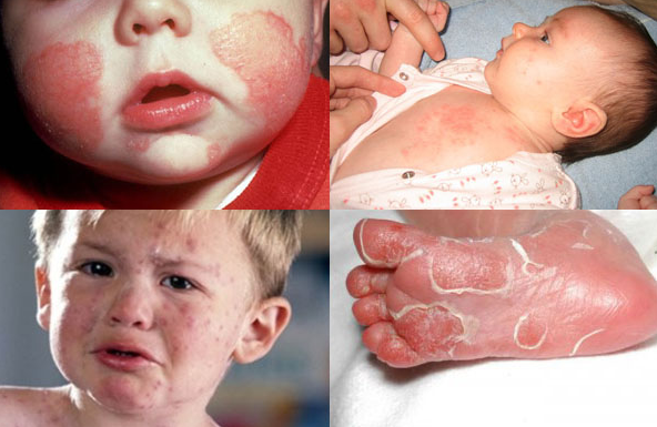 Bệnh giang mai bẩm sinh