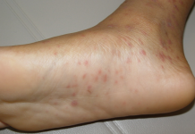 Điều trị bệnh vảy phấn hồng Gibert