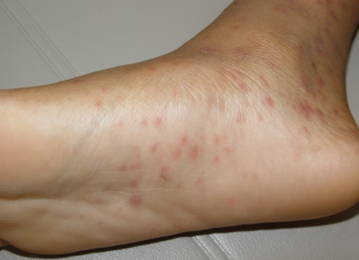 Điều trị bệnh vảy phấn hồng Gibert