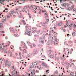 Một số thăm dò cận lâm sàng giúp chẩn nguyên nhân gây suy thận cấp