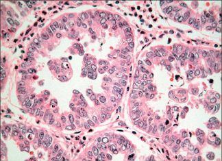 Một số thăm dò cận lâm sàng giúp chẩn nguyên nhân gây suy thận cấp