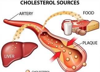 Tăng lipid máu và sự phân loại sự tăng lipoprotein máu Lipid máu