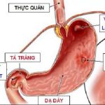 LOÉT DẠ DÀY TÁ TRÀNG. DỊCH TỄ VÀ GIẢI PHẪU BỆNH