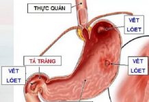 Điều trị chảy máu từ tĩnh mạch trướng thực quản, do K dạ dày, chảy máu đường mật và các nguyên nhân hiếm gặp khác