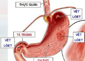 Những điều cần lưu ý vê bệnh viêm dạ dày mạn.