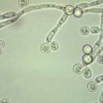 Điều trị bệnh nấm Candida