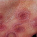 Nguyên nhân và biểu hiện bệnh hồng ban đa dạng