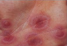 Nguyên nhân và biểu hiện bệnh hồng ban đa dạng