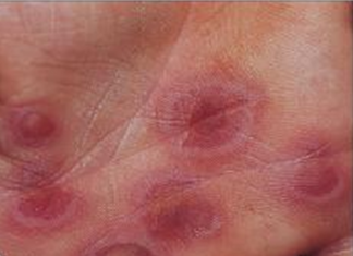 Nguyên nhân và biểu hiện bệnh hồng ban đa dạng