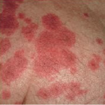 Nguyên nhân và biểu hiện hội chứng Lyell