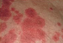 Nguyên nhân và biểu hiện hội chứng Lyell