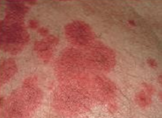 Nguyên nhân và biểu hiện hội chứng Lyell