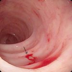 Chảy máu tiêu hóa thấp. Chảy máu từ ruột non