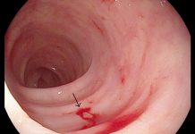 Chảy máu từ đại tràng