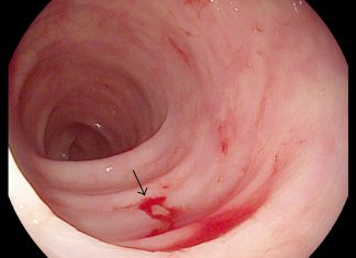 Chảy máu tiêu hóa thấp. Chảy máu từ ruột non