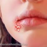 Các bài thuốc trừ phong thấp trong y học cổ truyền