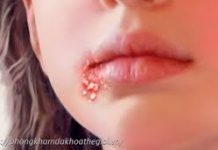 Các bài thuốc trừ phong thấp trong y học cổ truyền