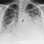 Một số điều cần biết phù phổi cấp huyết động đối với thai nghén