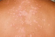 Điều trị bệnh lang ben bệnh lang ben