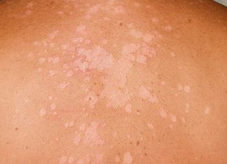 Biểu hiện bệnh lang ben bệnh lang ben